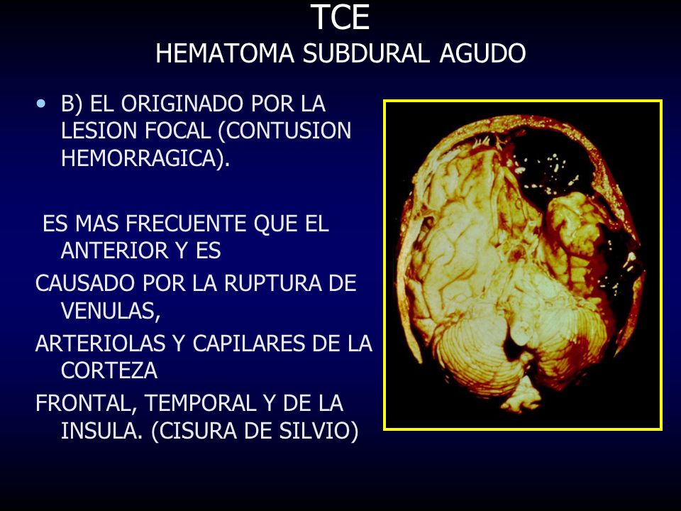 tecnica quirurgica de drenaje de hematoma subdural